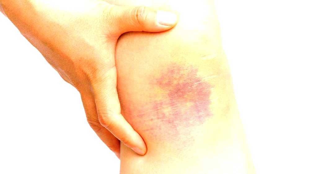 Bruise