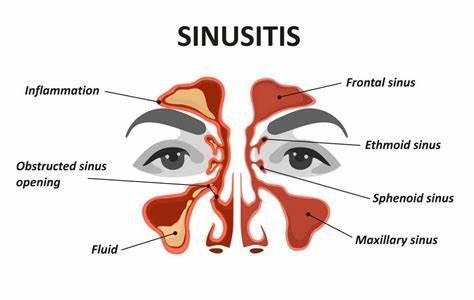 Acute Sinusitis – Allied ENT