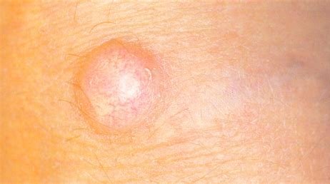 Image result for free to use images of cysts